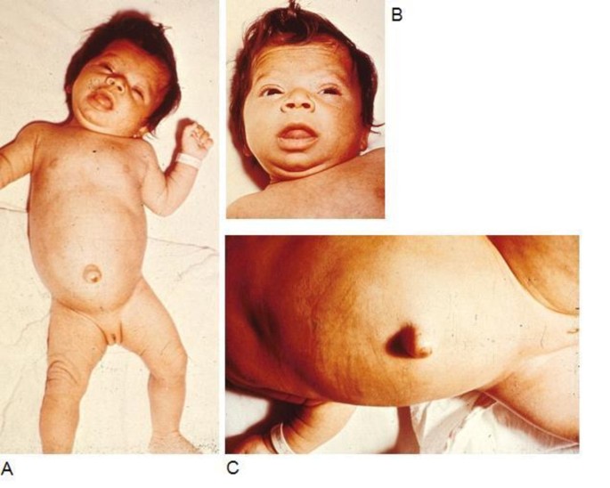 Thyroid Hypoplasia as a Cause of Congenital Hypothyroidism in