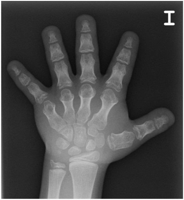 Brachydactyly E: isolated or as a feature of a syndrome, Orphanet Journal  of Rare Diseases