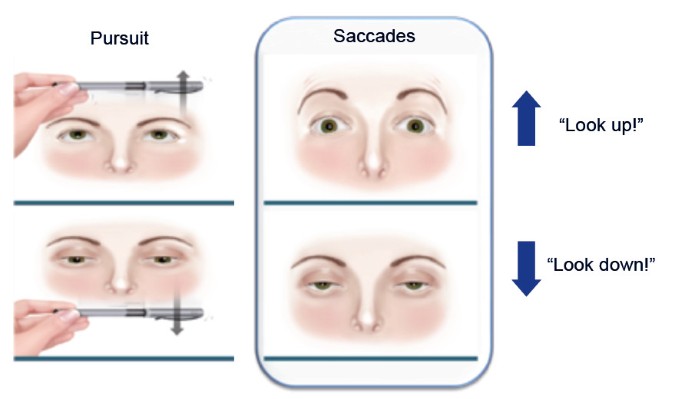 Doença de Niemann-Pick tipo C: apraxia do olhar e ataxia recessiva