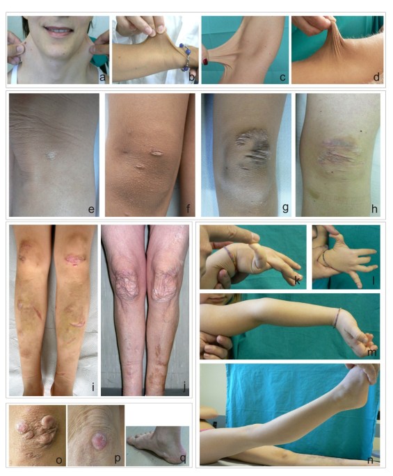 Clinical and molecular characterization of 40 patients with classic Ehlers– Danlos syndrome: identification of 18 COL5A1 and 2 COL5A2 novel mutations |  Orphanet Journal of Rare Diseases