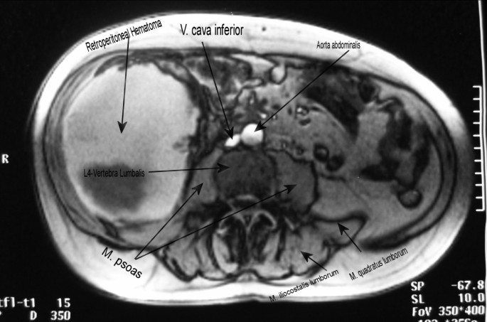 Sudden onset flank pain: a case report of retroperitoneal hemorrhage s