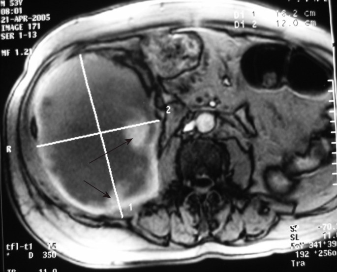 Sudden onset flank pain: a case report of retroperitoneal hemorrhage s