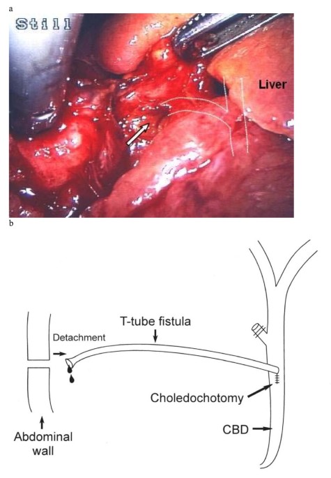 Biliary peritonitis caused by a leaking T-tube fistula disconnected at the  point of contact with the anterior abdominal wall: a case report | Journal  of Medical Case Reports | Full Text