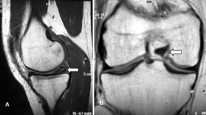 Simultaneous bicompartmental bucket-handle meniscal tears with intact anterior cruciate ligament: a case report | Journal of Medical Case Reports