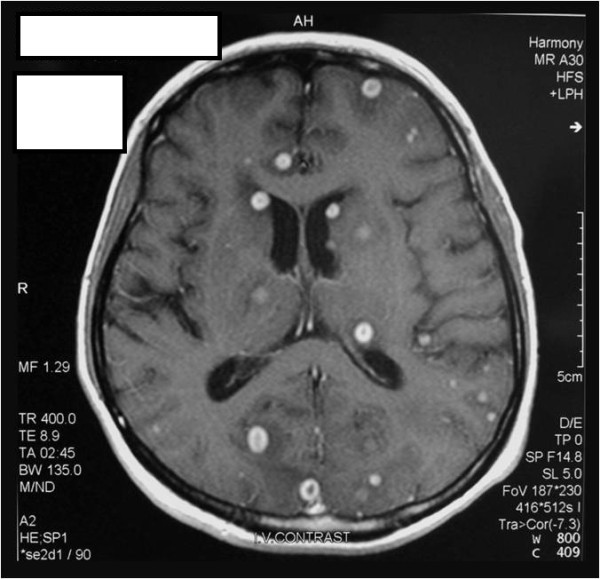 Magnetic Resonance Imaging Features of Cerebral Ring-Enhancing Lesions with  Different Aetiologies: a Pictorial Essay