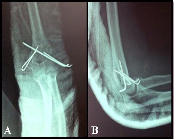 A case of bilateral elbow dislocation in a patient with Rubinstein