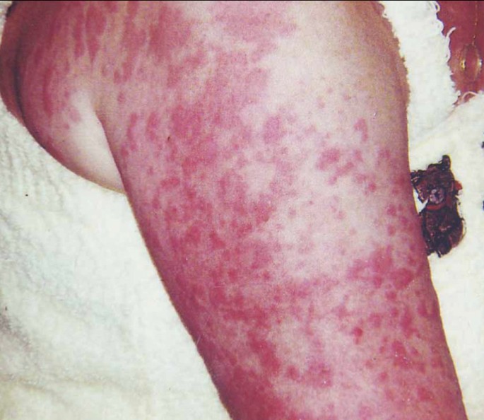Cold-induced urticaria with a familial transmission: a case report and  review of the literature | Journal of Medical Case Reports | Full Text