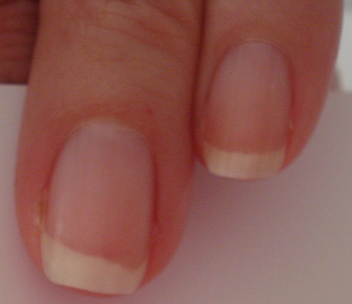 White spots on nails from bartending? Does anyone else get this? Can this  be related to bartending at all? : r/bartenders