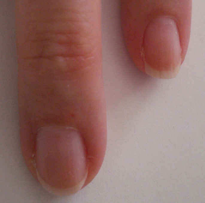 Blue, pale, or grey fingernails or lips | COVID infection | 11alive.com