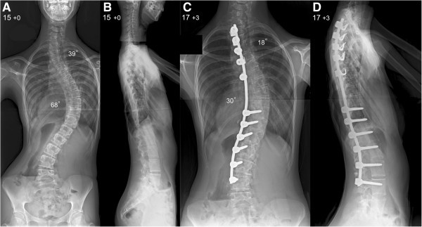 Rubinstein-Taybi syndrome  Radiology Reference Article