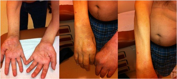 Chiari malformation type I with cervicothoracic syringomyelia masquerading  as bibrachial amyotrophy: a case report | Journal of Medical Case Reports |  Full Text