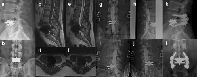 Bilateral central fracture-dislocation of hips after myelography