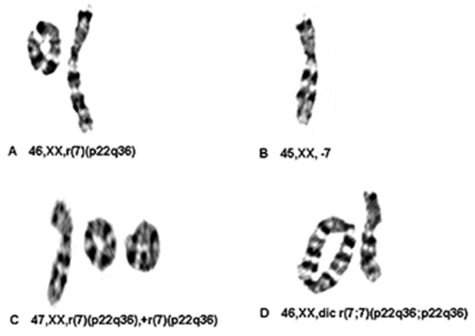 Karyogram of the baby showing ring chromosome 4. | Download Scientific  Diagram