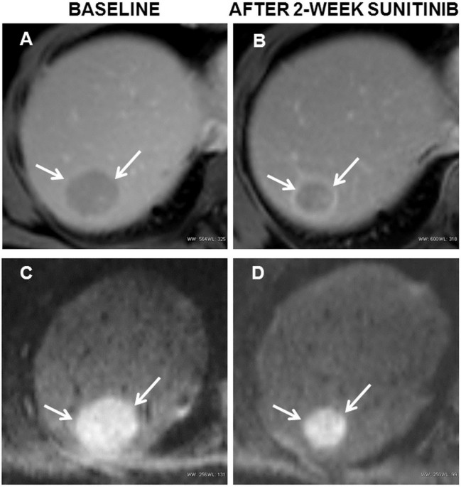 ADC values (mm2/s) of tumor and liver at different time points.