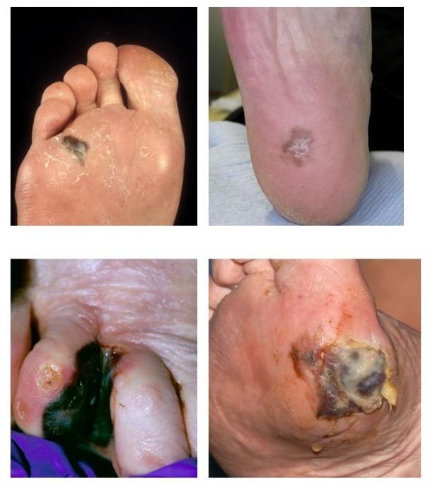 Clinical guidelines for the recognition of melanoma of the foot and nail  unit | Journal of Foot and Ankle Research | Springer Nature Link