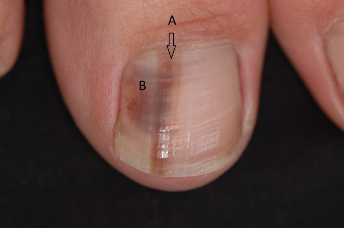 Nail pigmentation is a common presentation. Whilst most causes are benign  eg fungal infection and trauma, nail melanoma needs to be consi... |  Instagram