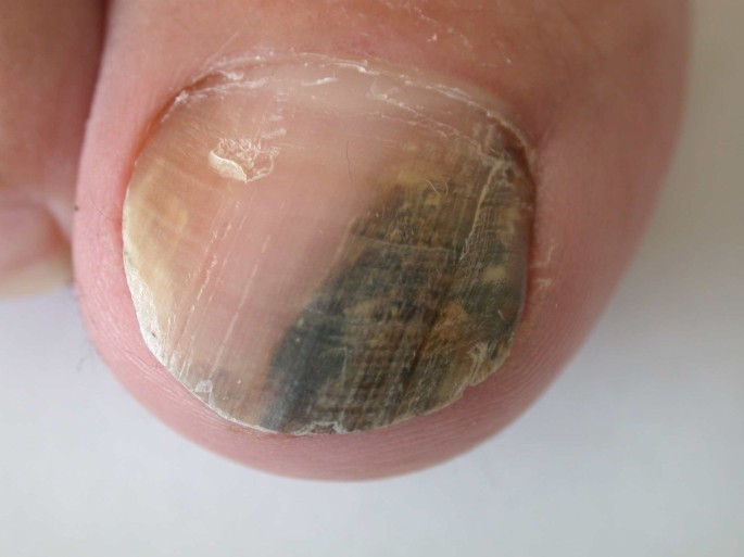Essex beautician spots client's nail stripe as skin cancer | Daily Mail  Online
