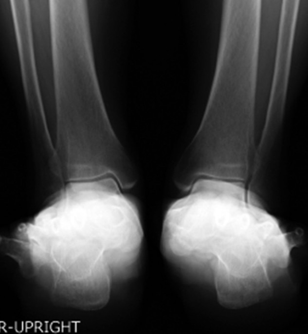 Radiographic Evaluation: Calcaneal Fractures : Wheeless' Textbook of  Orthopaedics