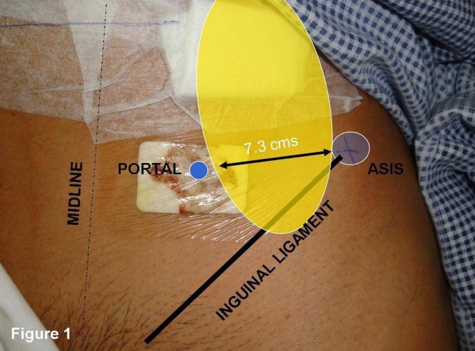 meralgia paresthetica b12 injections Persistent bilateral anterior hip pain in a young adult due to paresthetica: a case report | Cases Journal MIC B12 Injection - ObagiHide Buy More and Save:1 Box $69.00