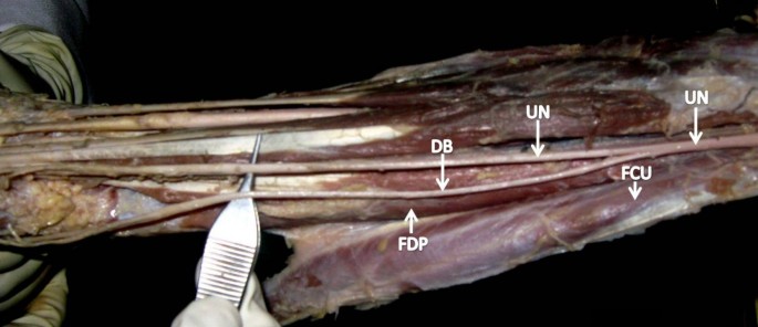 Interfascicular Anatomy of the Motor Branch of the Ulnar Nerve: A Cadaveric  Study - ScienceDirect
