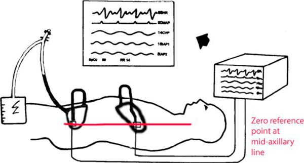 Summary of effects of different body positions on IAP compared to the