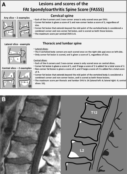 ASDAS states in patients stratified by baseline MRI/CRP status.