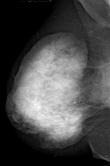 Calibrated Digital Mammography Scale