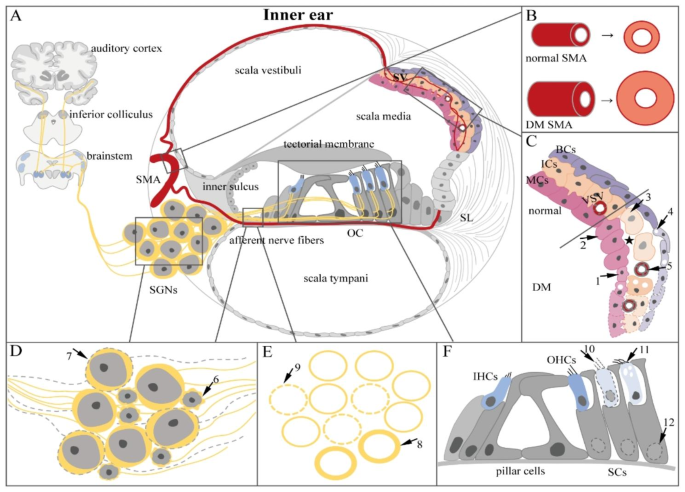 glutathione and hearing loss Effects of Methionine on Acute Ototoxicity Induced by Amikacin and Furosemide in an Animal Model of Threshold Decrease Diabetes mellitus and hearing loss