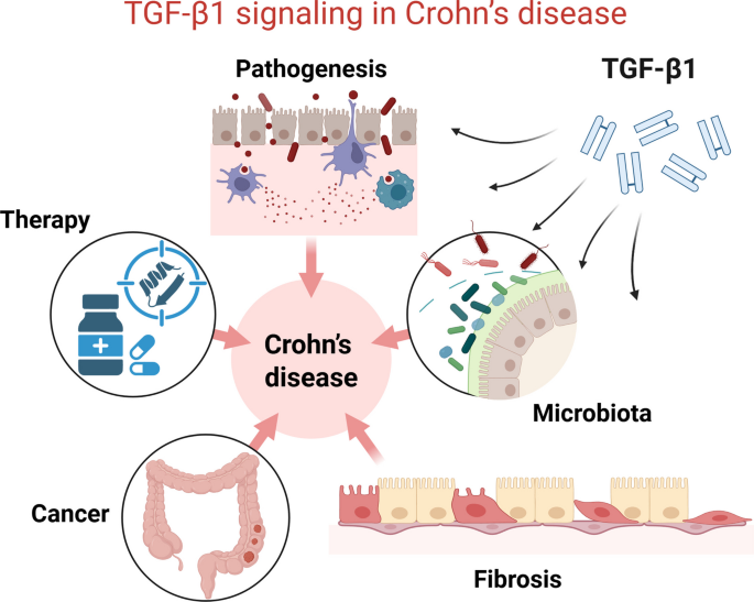 TGF-β1 signaling in Crohn’s disease