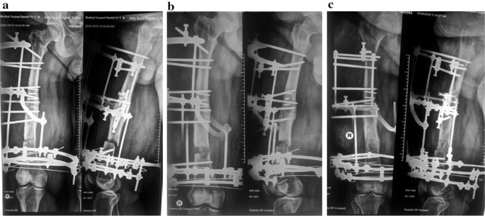 Full-ring Ilizarov frame applied for lengthening of tibia.