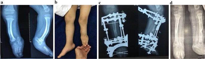 Llizarov Tibia Ring External Fixator Lengthening for Delayed