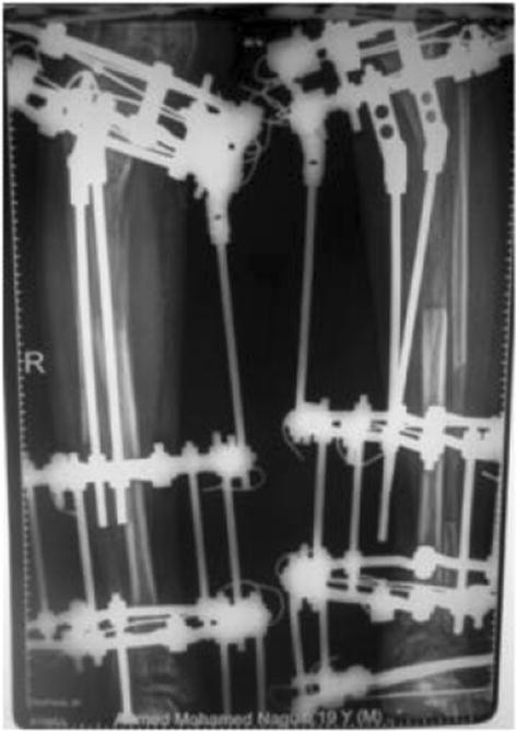 Four ring frame designing with spread along entire length of tibia