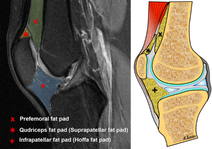 The relationship between quadriceps fat pad syndrome and patellofemoral  morphology: a case–control study | Journal of Orthopaedics and Traumatology  | Full Text