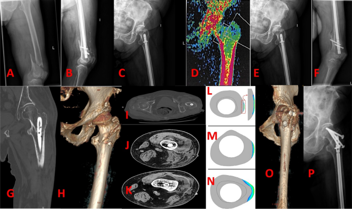 Exchange Nailing for Aseptic Nonunion of the Femoral Shaft after Intramedullary  Nailing