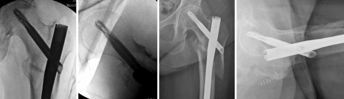 Subtrochanteric fractures in elderly people: functional and radiographic  outcomes after intramedullary locked nail fixation with