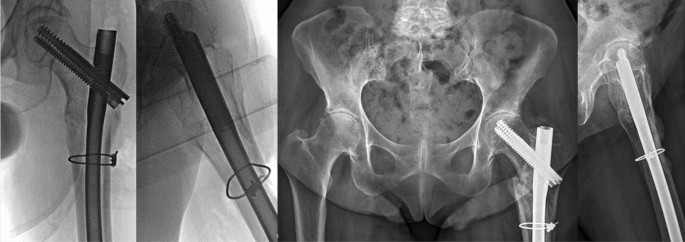 Outcome Of Proximal femoral Nail in management of pertrochanteric fracture  | Orthopaedic Journal of M. P. Chapter