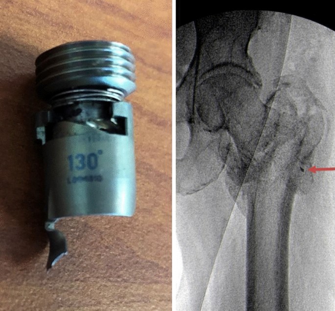 Proximal Femoral Bionic Nail,Medical Device Manufacturers -Double Medical
