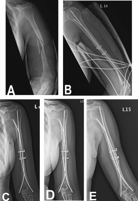 Arthroscopic intramedullary nailing of humeral fractures through the  rotator interval - ScienceDirect