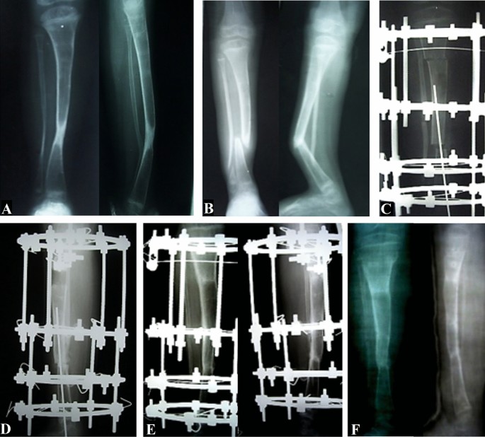 Cureus, Congenital Pseudoarthrosis of Tibia With Anterolateral Bowing  Treated With Ilizarov Ring Fixator: A Case Report