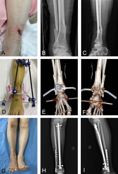 Expert Tibial Nails for Treating Distal Tibial Fractures With Soft Tissue  Damage: A Patient Series - ScienceDirect