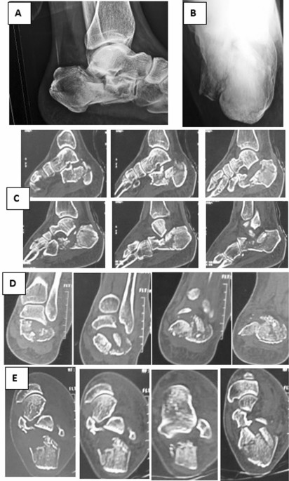 MILA surgery: (a) preoperative left calcaneus axial X-ray slice; (b)... |  Download Scientific Diagram