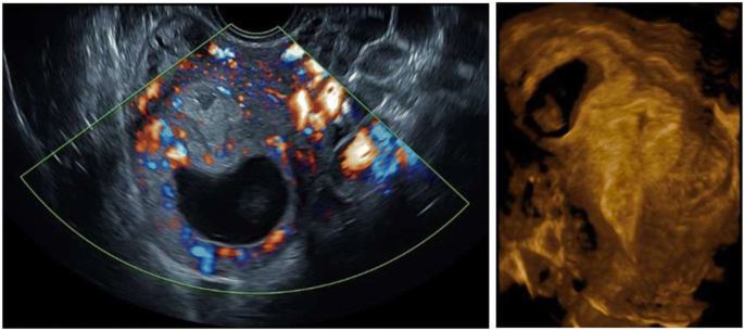 Ectopic Pregnancy Imaging: Practice Essentials, Magnetic Resonance Imaging,  Ultrasonography