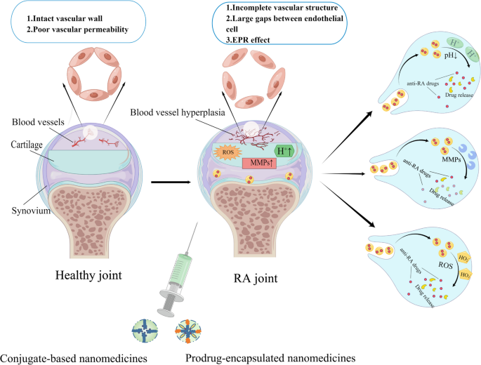 glutathione iv for rheumatoid arthritis Prodrug-based nanomedicines for rheumatoid arthritis | Discover Nano