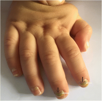 How To Prevent & Treat Skin Peeling Around Nails? – Vedix