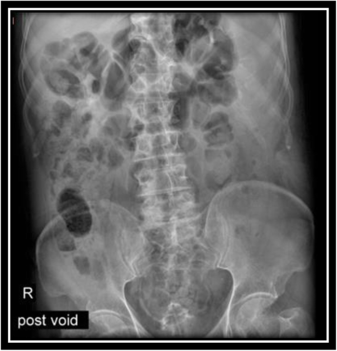 Non-penetrating traumatic psoas muscle hematoma presenting with gross  hematuria: a case report | International Journal of Emergency Medicine |  Full Text