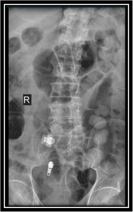 Non-penetrating traumatic psoas muscle hematoma presenting with gross  hematuria: a case report | International Journal of Emergency Medicine |  Full Text