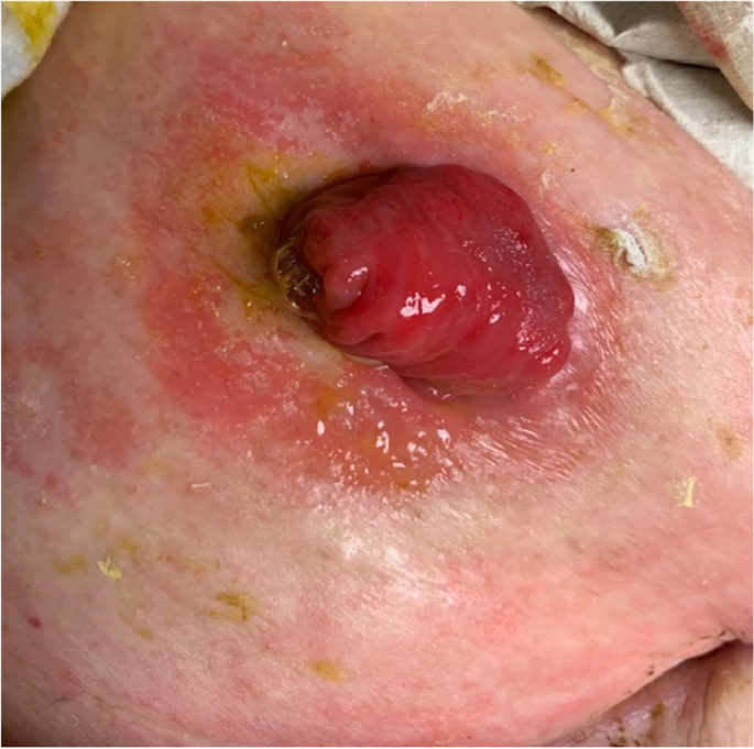 Stoma-related complications and emergencies, International Journal of  Emergency Medicine