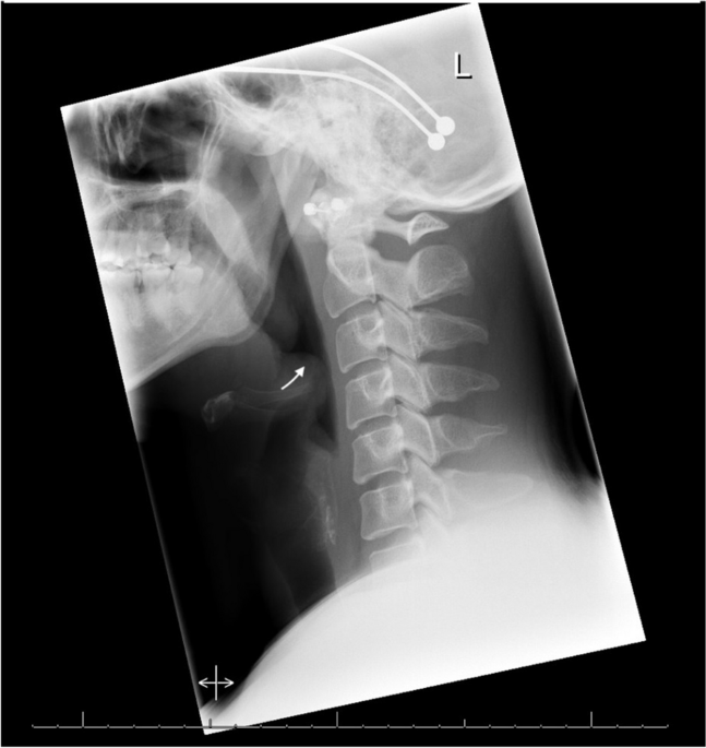 Vaping-induced acute epiglottitis: a case report | International Journal of  Emergency Medicine | Springer Nature Link