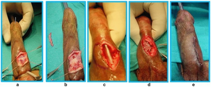 a Large penile skin defect after debridement at full stretch. b Penile