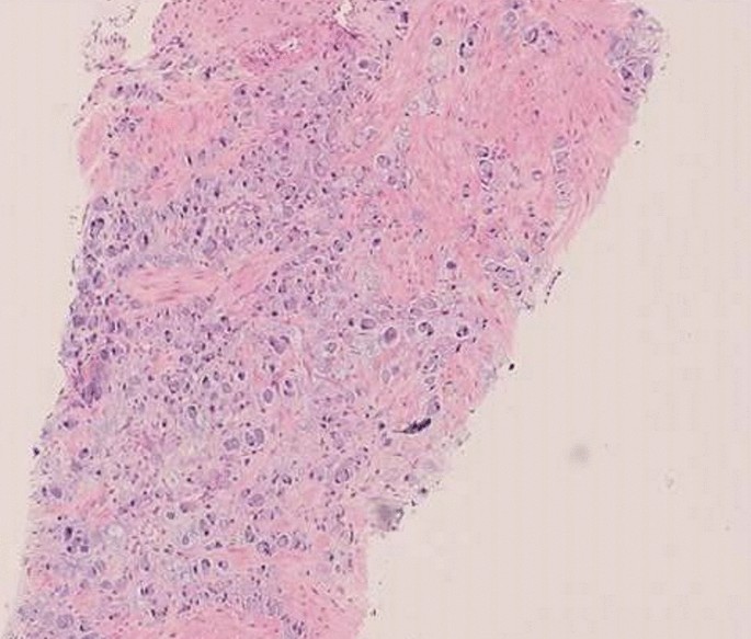 Primary signet‐ring cell carcinoma of the renal pelvis: An autopsy case -  Iijima - 2022 - IJU Case Reports - Wiley Online Library